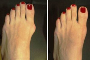 Bunions before and after treatment | Bunions Treatment