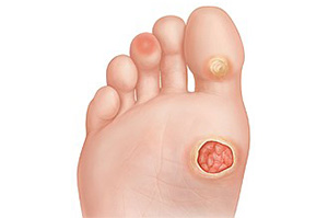 An illustration of a diabetic foot wound | Diabetic Wound Treatment