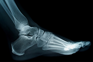 An x-ray of a fractured foot | Foot and Ankle Specialist