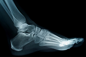 An x-ray of a foot fracture | Foot Fracture