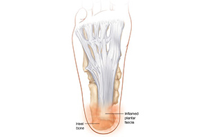 An illustration showing heel pain | Heel Pain