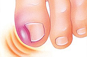 A diagram of an ingrown toenail | Foot and Ankle Specialist