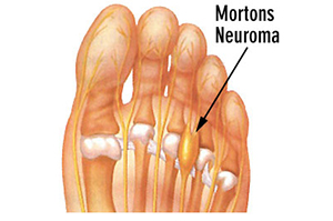 A diagram of Morton’s Neuroma | Foot and Ankle Specialist