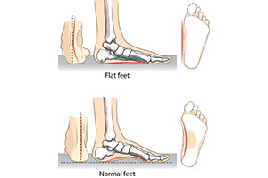 A diagram of a normal foot vs a flatfoot | Foot and Ankle Specialist