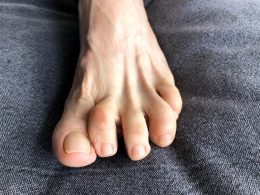 Hammertoe