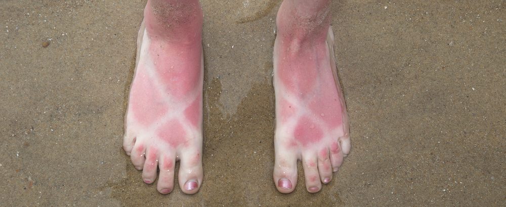 sunburn on feet