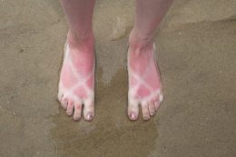 sunburn on feet