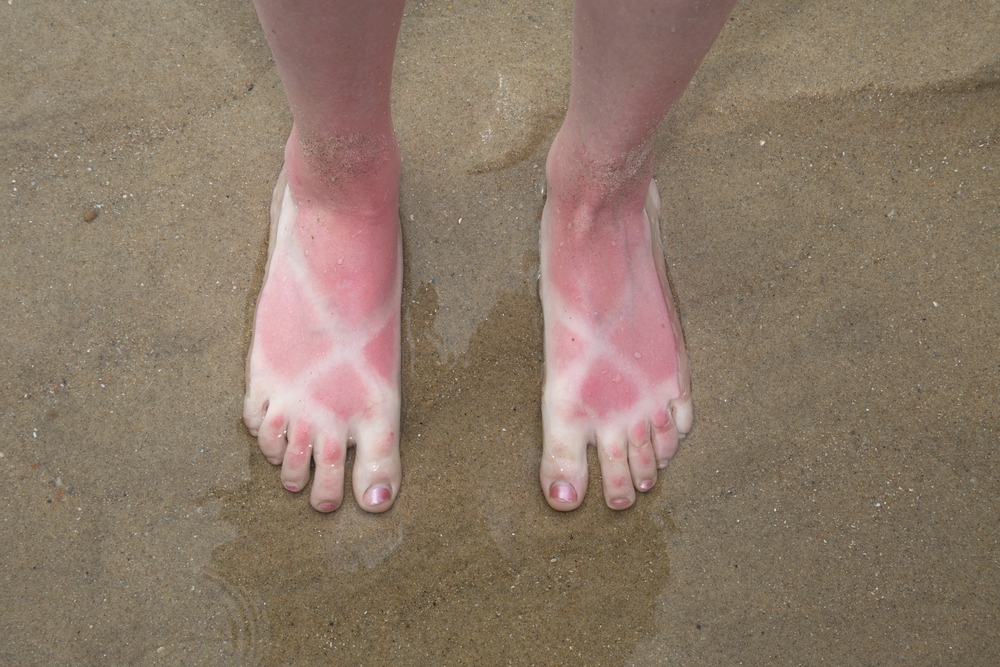Natural Sunburn Relief from the Eastern Shore