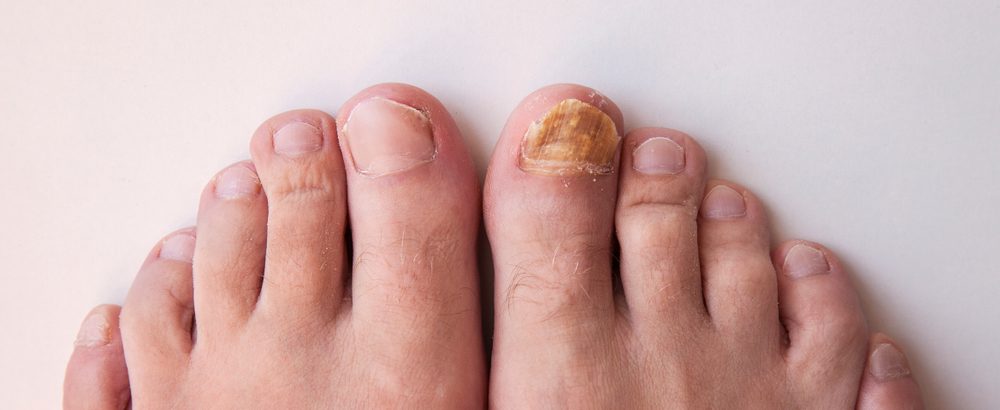 Toenail fungus