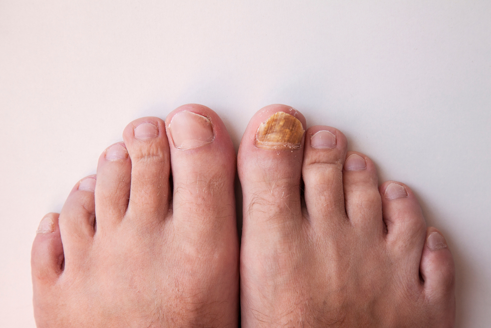 The Truth About Toenail Fungus Treatment: Pure Skin Aesthetic & Laser  Center: Cosmetic Laser Centers
