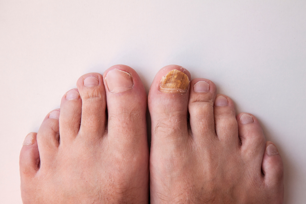 Is Nail Fungus Contagious? Preventing Toenail & Fingernail Fungus