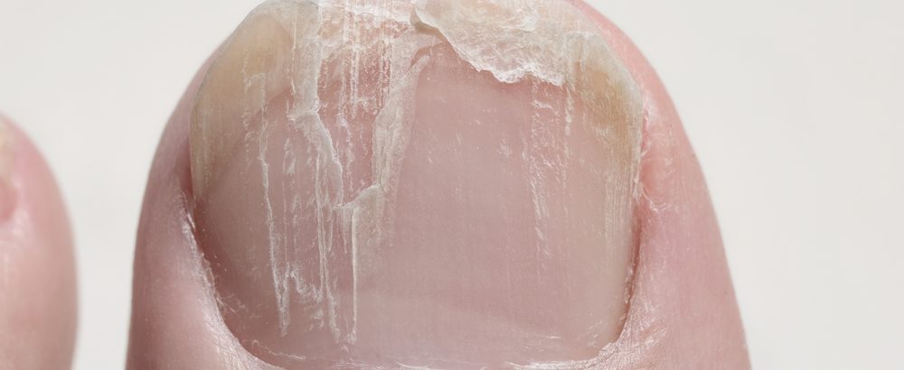 How to repair a tear in your nail 💅 - B+C Guides