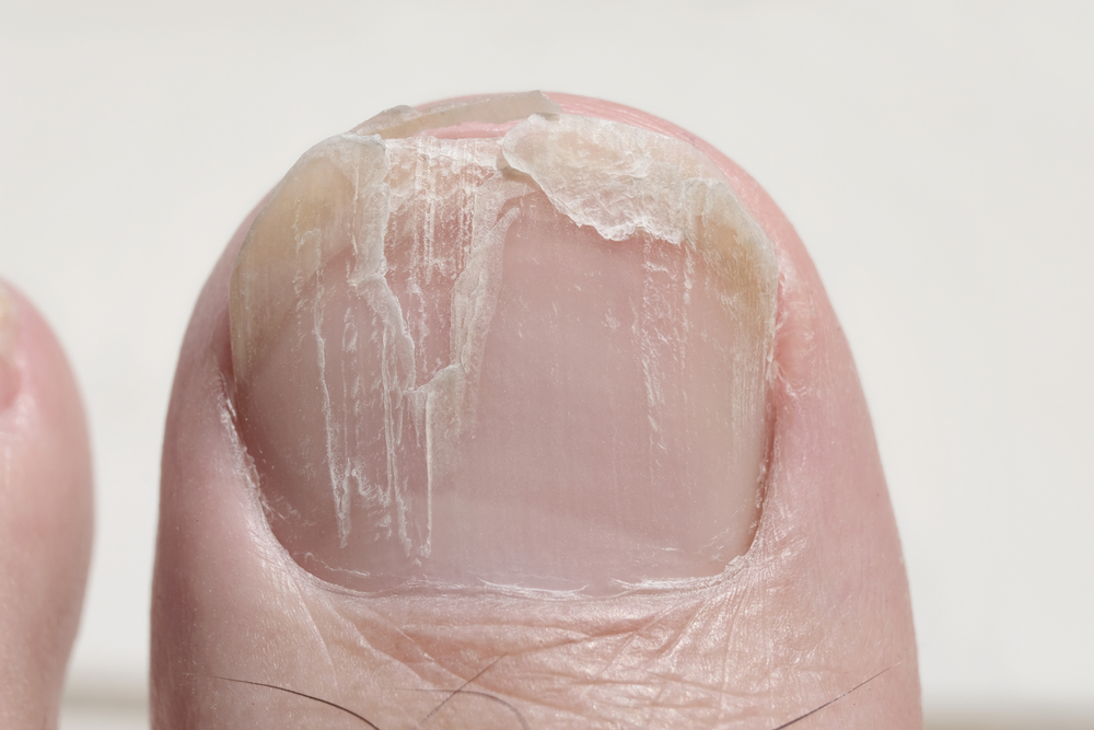 What Should You Do if a Toenail is About to Come Off?