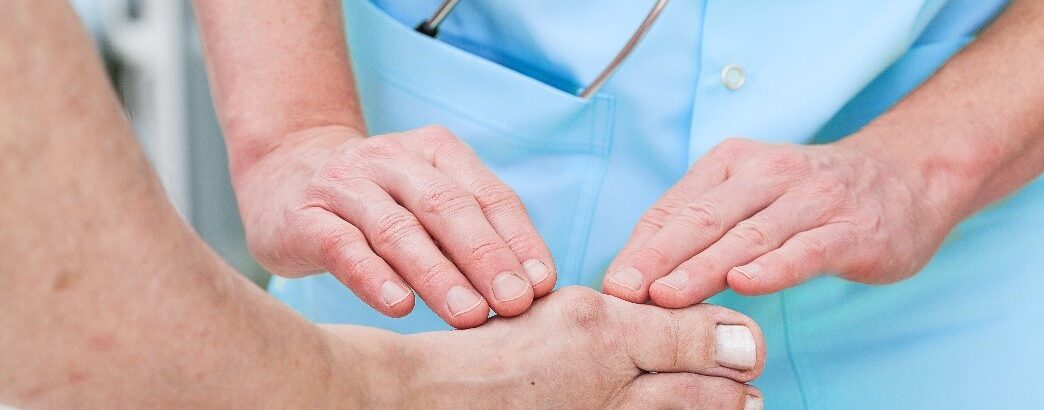 5 Non-Surgical Bunion Treatments